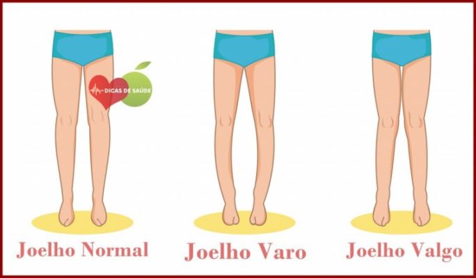Tratamento para pernas arqueadas